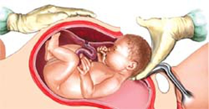 Nguyên nhân, dấu hiệu, cách điều trị và dự phòng vỡ tử cung